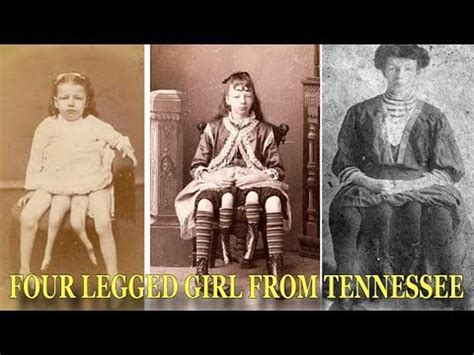 Life Of Four Legged Girl From Tennessee Josephine Myrtle Corbin
