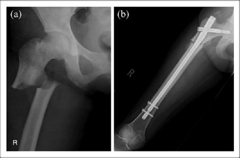 A Radiograph Showing Right Femoral Subtrochanteric Complete Fracture