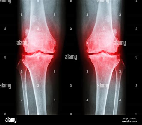 Osteoarthritis Both Knee Film X Ray Ap Anterior Posterior Of