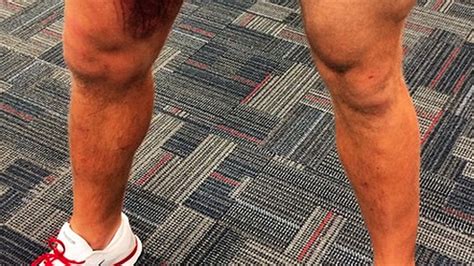 Jj Watt Posted The Grossest Picture Of A Leg Bruise Youll Ever See