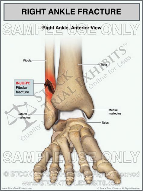 Ankle Fracture Of The Right Fibula Trial Exhibit Stock Trial Exhibits