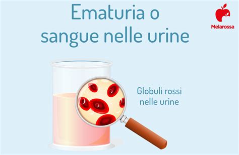 Sangue Nelle Urine Cosè Cause E Rimedi Dellematuria