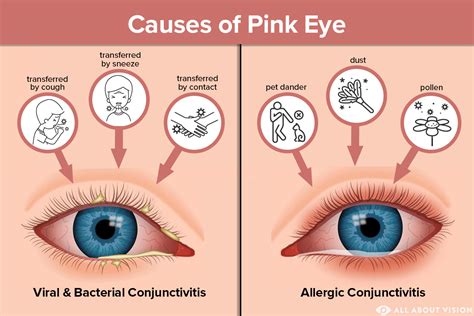 Pink Eye Conjunctivitis Causes All About Vision