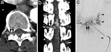 Multi Detector Row Computed Tomography Angiography In Diagnosing Spinal