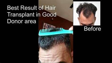 Best Result Of Hair Transplant In Good Donor Area Dr Navdeep Hair