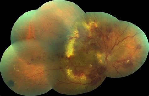 Coats Disease Retina Image Bank
