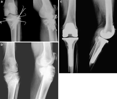 Total Knee Arthroplasty After Complex Tibial Plateau Fractures