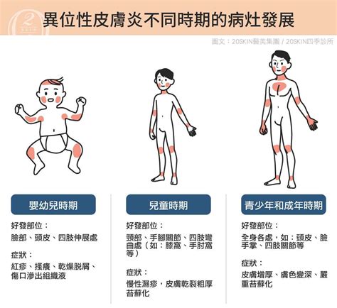 敏感肌難纏的異位性皮膚炎可以治癒嗎 台中 二林四季皮膚科 20SKIN美醫集團