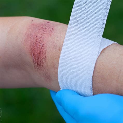 Wounds How Skin Can Regenerate After Severe Burns