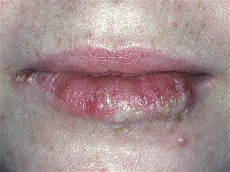 Lip Lesions In Images