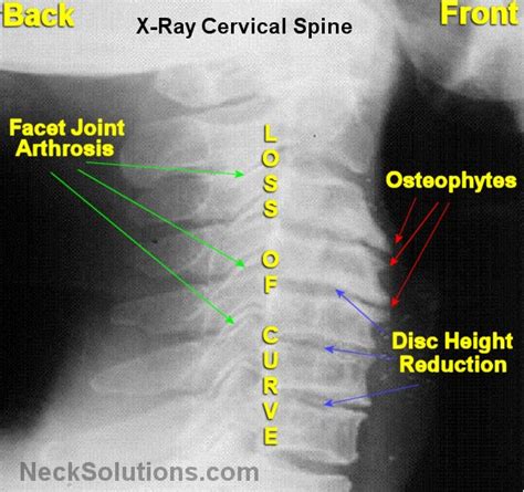 The purpose of this study was to assess the application of the radiographic index method to analyze the radiographic features of. Cervical Spondylosis - Cervical Spondylosis Symptoms