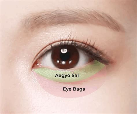 Does Removal Of Eye Bags Require Surgery Singapore Plastic Surgeon