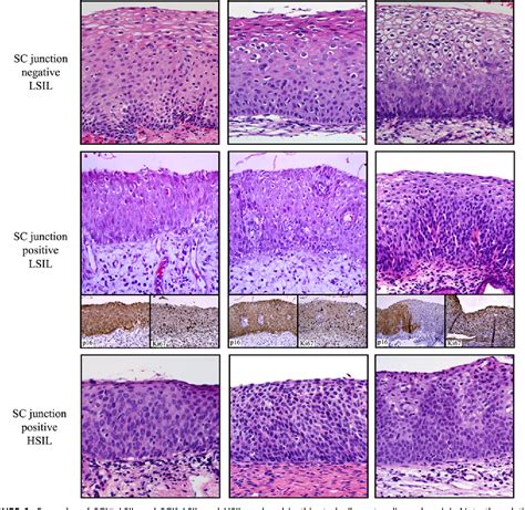 Pdf Cervical Squamocolumnar Junction Specific Markers Define Distinct