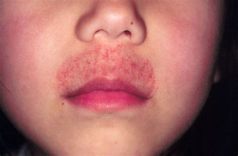 Allergic Reaction Rash On Upper Lip
