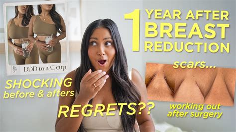 Watch This Before You Consider A Breast Reduction Scars Regrets And Before And Afters 1 Year