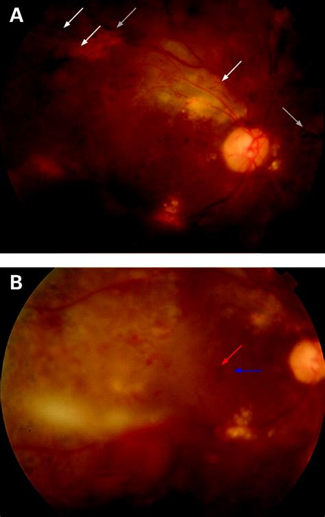 Retinal Detachment With Macular Hole Following Intravitreal Bevacizumab