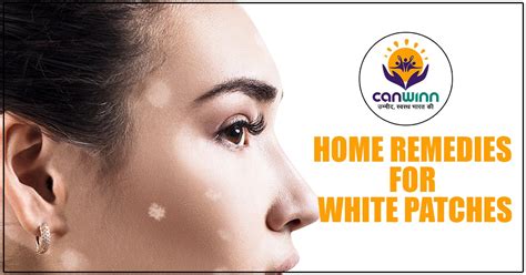 White Patches Home Remedies For White Patches Canwinn