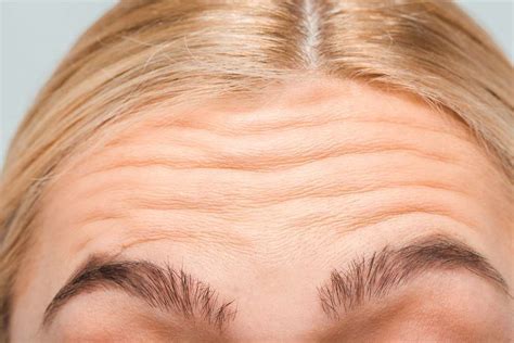 Say Goodbye To Forehead Wrinkles Without Botox 14 Effective Methods