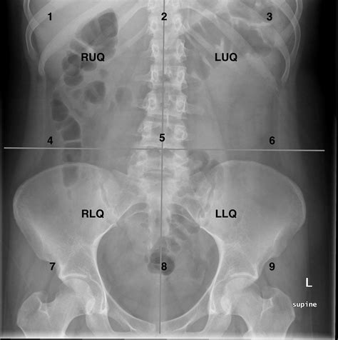 Sintético 103 Foto Division De Abdomen En 9 Cuadrantes El último