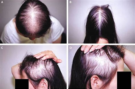 Male Or Female Pattern Baldness Causes And Baldness Treament