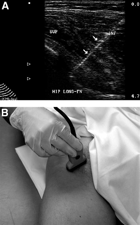 Office Based Ultrasound Guided Intra Articular Hip Injection Technique For Physiatric Practice