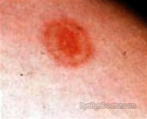 Fungal Rash On Buttocks Pictures Photos