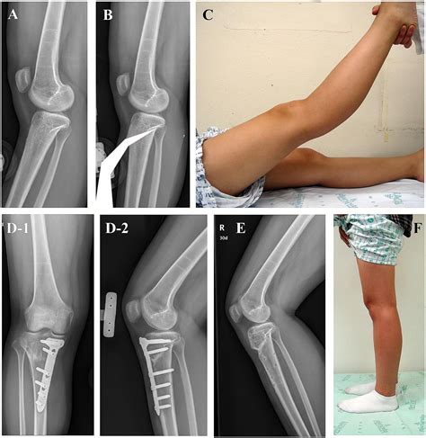 Proximal Tibial Anterior Open Wedge Oblique Osteotomy A Novel
