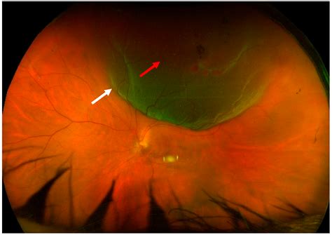 Diagnostics Free Full Text Two Port Dry Vitrectomy As A New