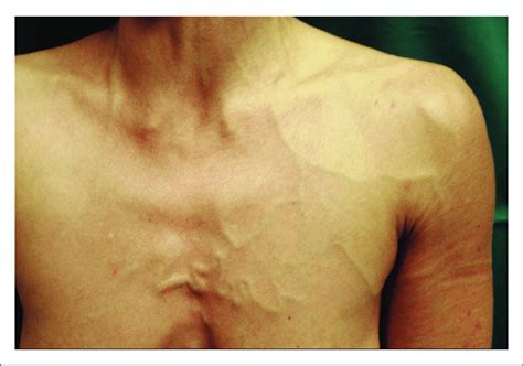 Dilatation Of Subcutaneous Collateral Veins In A Patient With