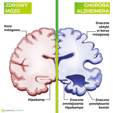 Choroba Alzheimera Przyczyny Objawy Diagnoza I Leczenie Bj Medical