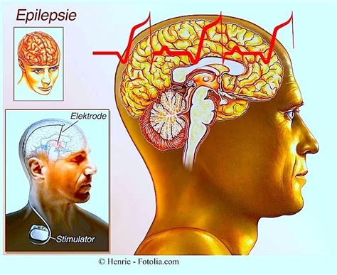Symptome Der Epilepsie Und Epileptische Anfälle Bei Kindern Und