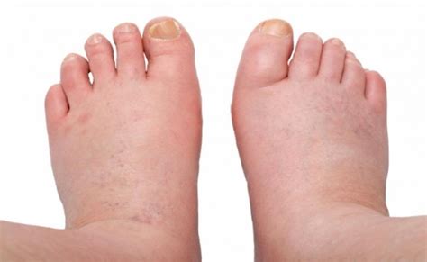 Swollen Feet Causes And Remedies For Inflammation From Doctor