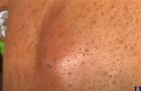 Massive Cyst On The Back Popped New Pimple Popping Videos