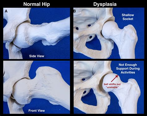 Hip Instability Treatment North Hollywood Los Angeles Orthopedic
