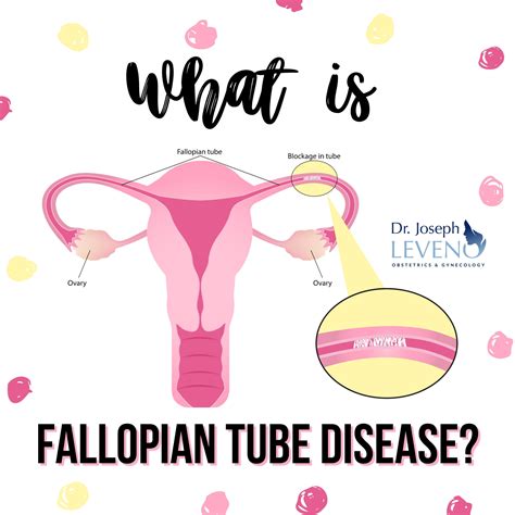 Fallopian Tube Disease Plano Texas Woman Obgyn Doctor Dr Joseph Leveno