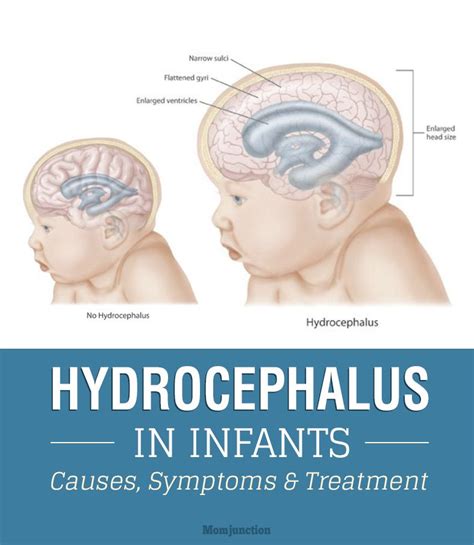 Hydrocephalus In Babies Causes Symptoms And Treatment In 2020 Child