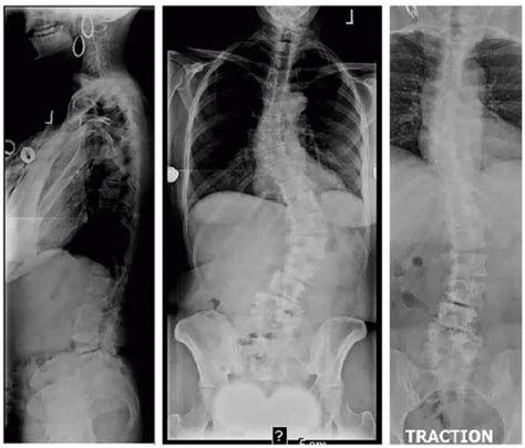 Posterior Correction Of Scoliosis Musculoskeletal Key