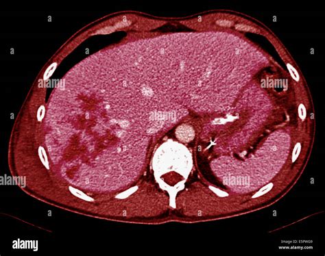Axial Computed Tomography Ct Scan Of The Abdomen Showing Contusions