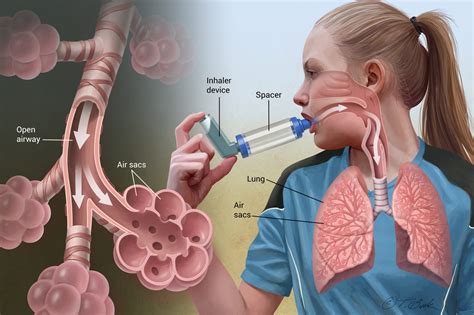 Asthma Center Symptoms Causes Diagnosis And Treatment Health Normal