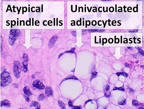 What Is The Difference Between Lipoma And Liposarcoma Compare The