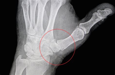 Hand411 Basilar Thumb Cmc Arthritis