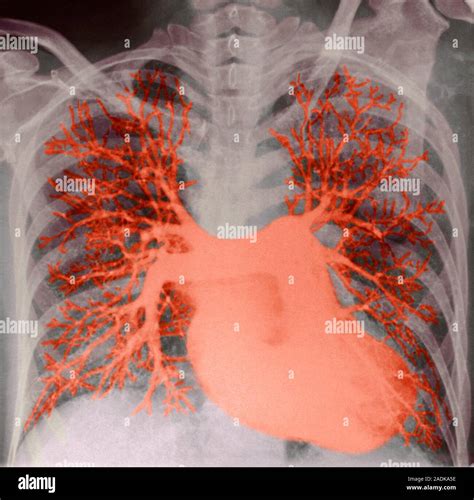 Lung Blood Vessels Coloured Angiogram Of The Heart And Pulmonary