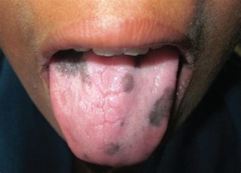 Hyperpigmentation Seen On The Dorsal Surface Of The Ton Open I
