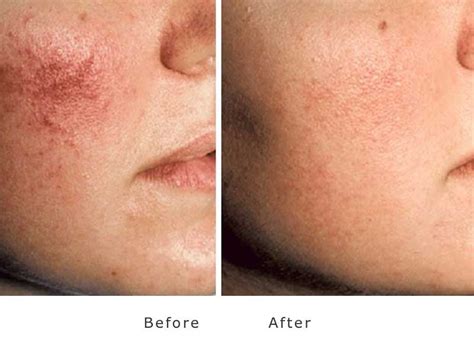 Rosacea And Acne Treatment At My Face Aesthetics Laser Clinic Bolton