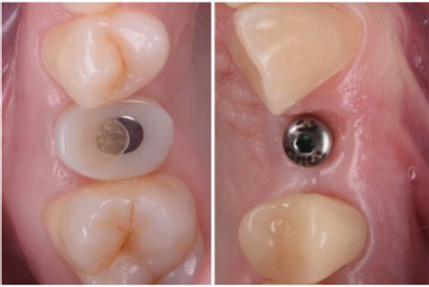 Maintaining Tissue Architecture In Immediate Implant Placement