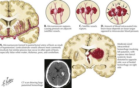 Intracerebral Hemorrhage Neupsy Key