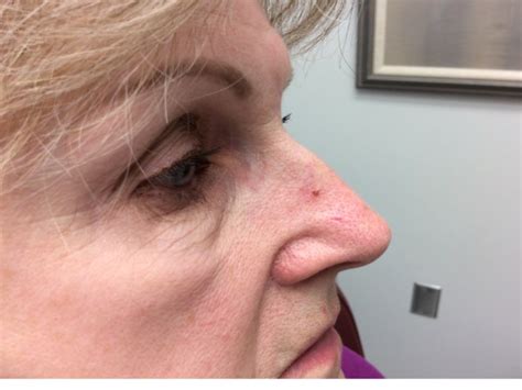 Basal Cell Carcinoma Early Stages Nose