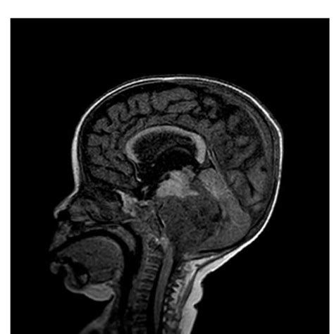 Axial Brain Ct Slice Showing Tumor In Fourth Ventricle With