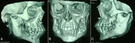 Cherubism With Multiple Dental Abnormalities A Rare Presentation Bmj Case Reports