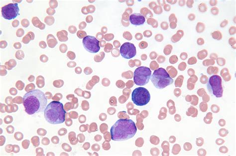 White Blood Cells May Play Role In Spread Of Cancer
